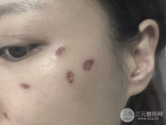 點(diǎn)痣后1-7天