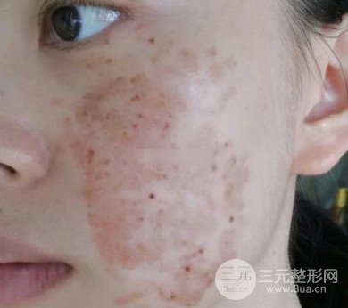 激光祛黃褐斑會反彈嗎