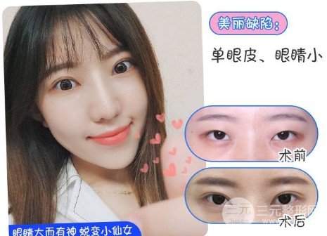 雙眼皮手術(shù)后恢復(fù)期