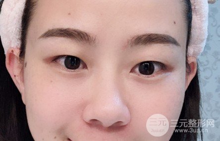 割雙眼皮恢復(fù)多久