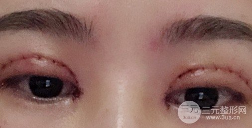 割雙眼皮恢復(fù)多久