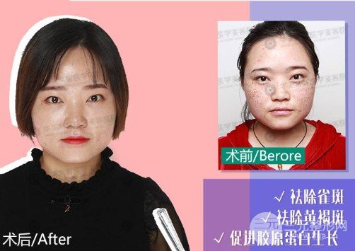 蜂巢激光祛斑果