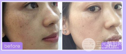 激光祛斑有果嗎