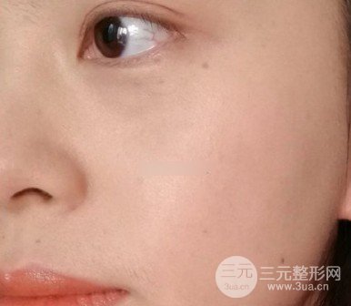 激光祛斑有果嗎