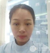 雙眼皮失敗的八種圖片，導(dǎo)致失敗的原因有哪些？