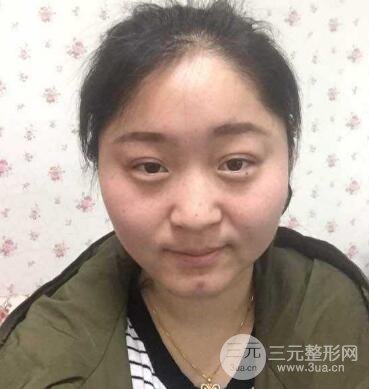 雙眼皮失敗的八種圖片