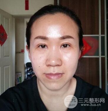 雙眼皮失敗的八種圖片