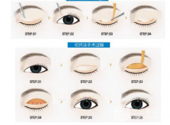 割雙眼皮有哪些風(fēng)險？如何避免風(fēng)向？