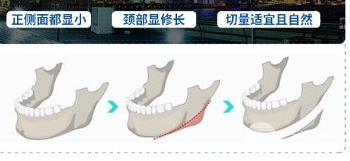 磨下頜角手術案例合集，磨骨手術科普~