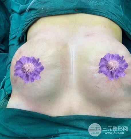 胸部太大帶來的煩惱