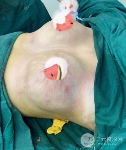 進(jìn)行乳房縮小術(shù)