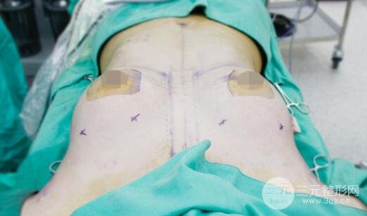 乳房縮小手術(shù)的特點(diǎn)是什么?