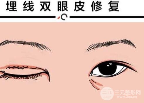 做埋線后老了的危害