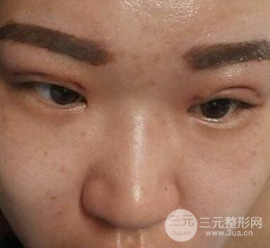 做埋線后老了的危害