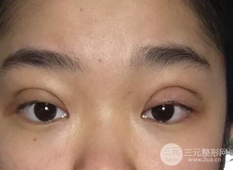 做埋線后老了的危害