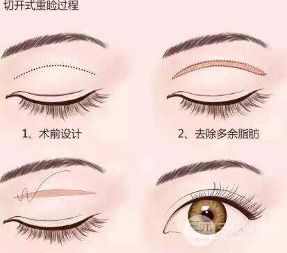 納米微創(chuàng)和全切哪個好