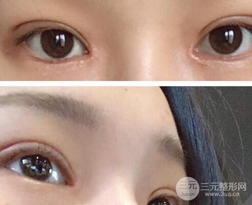 納米微創(chuàng)和全切哪個好