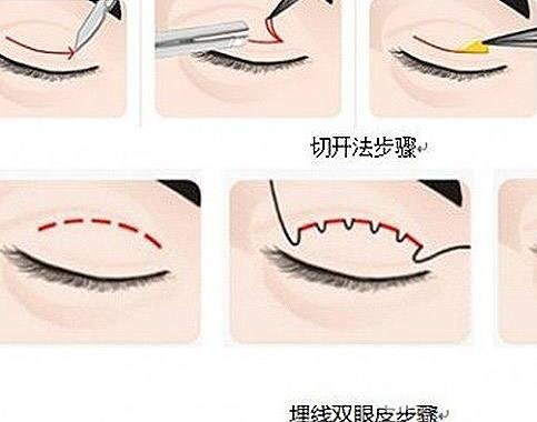 埋線雙眼皮過程圖解