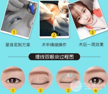 埋線雙眼皮過程圖解