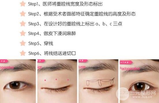 埋線雙眼皮過程圖解