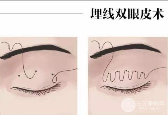 埋線雙眼皮過程圖解