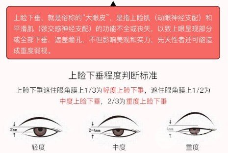 上瞼下垂恢復(fù)期是多久