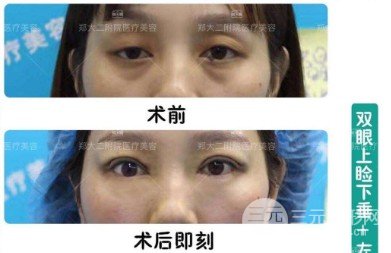 上瞼下垂恢復(fù)期是多久