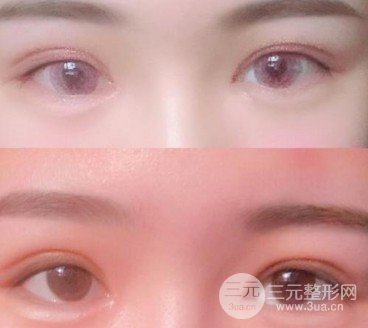 上瞼下垂恢復(fù)期是多久