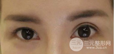 雙眼皮失敗的八種圖片