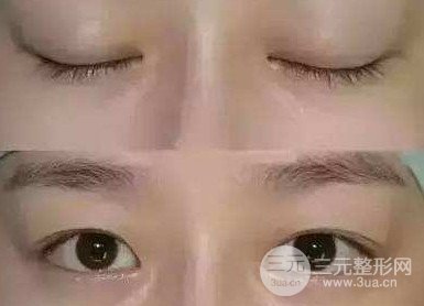 雙眼皮失敗的八種圖片