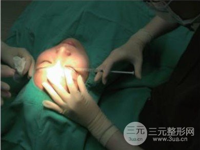 雙眼皮失敗的八種圖片