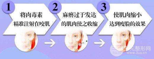 進(jìn)口注射瘦臉多少錢