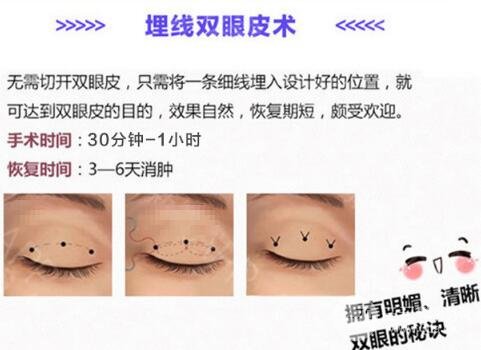 做雙眼皮埋線好還是全切好