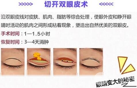 全切雙眼皮手術(shù)
