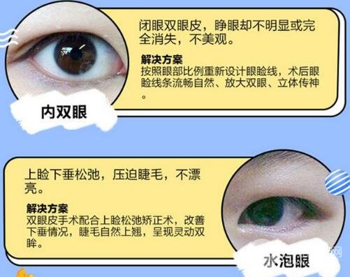 做雙眼皮埋線好還是全切好