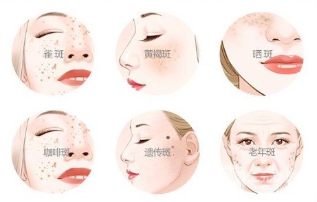 蜂巢激光祛斑的弊端