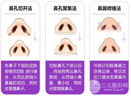 縮鼻翼頭要多少錢