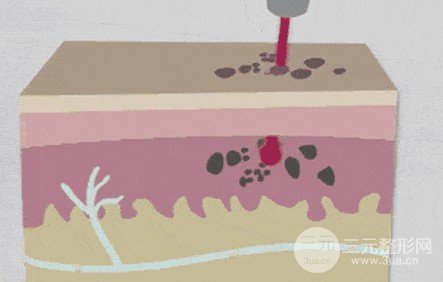 蜂巢激光祛斑注意事項