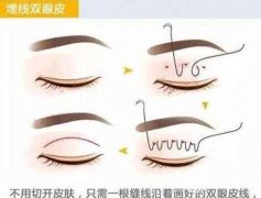 埋線不滿意拆線麻煩嗎？注意事項(xiàng)有哪些？