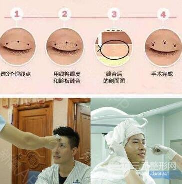 埋線不滿意拆線麻煩嗎