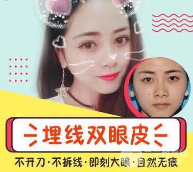 埋線不滿意拆線麻煩嗎