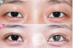 歐式眼與芭比眼的區(qū)別，超詳細(xì)介紹~