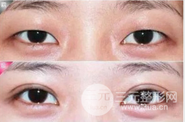 歐式眼與芭比眼的區(qū)別