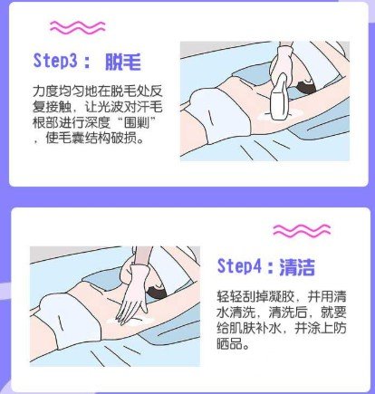 冰點脫毛維持時間