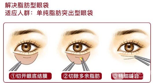 吸脂去眼袋多久能恢復(fù)