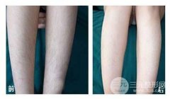 怎么樣脫毛降低風(fēng)險(xiǎn)又基本？或許你聽過激光脫毛?