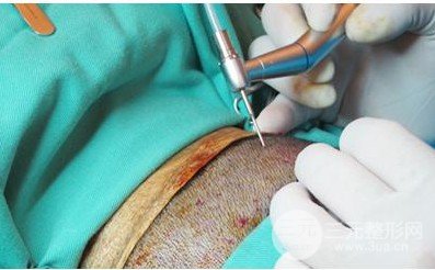 補(bǔ)發(fā)植發(fā)是真的有嗎