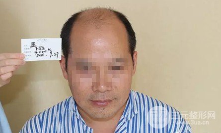 補(bǔ)發(fā)植發(fā)是真的有嗎