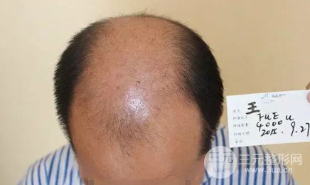 補(bǔ)發(fā)植發(fā)是真的有嗎