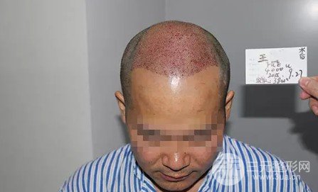 補(bǔ)發(fā)植發(fā)是真的有嗎